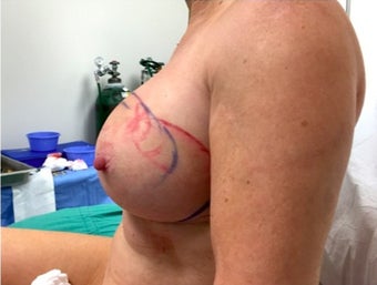 45-54 year old woman treated with Fat Transfer 2280017