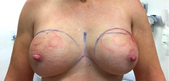 45-54 year old woman treated with Fat Transfer after 2280017