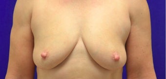 45-54 year old woman treated with Fat Transfer before 2280017