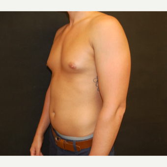 25-34 year old man treated with Male Breast Reduction before 3180929