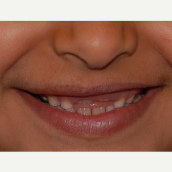 17 or under year old woman treated with Facial Reconstructive Surgery after 3625154