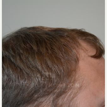 25-34 year old man treated with Hair Transplant before 3468134
