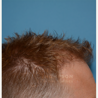 25-34 year old man treated with Hair Transplant after 3468134