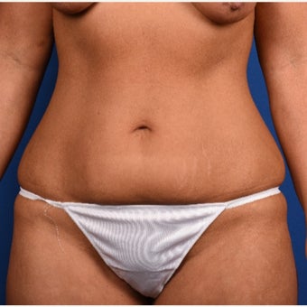 35-44 year old woman treated with Tummy Tuck before 2083799