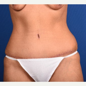35-44 year old woman treated with Tummy Tuck after 2083799