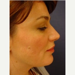 35-44 year old woman treated with Thread Lift before 2079301
