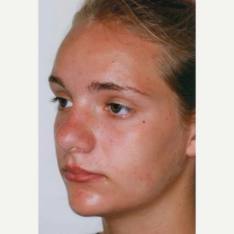 17 or under year old woman treated with Rhinoplasty before 3406171