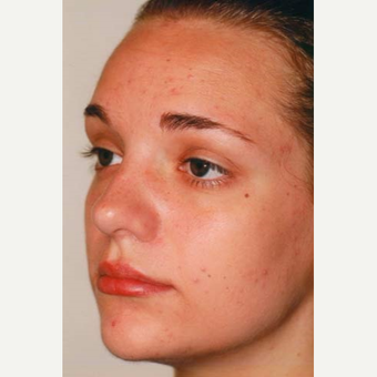 17 or under year old woman treated with Rhinoplasty after 3406171