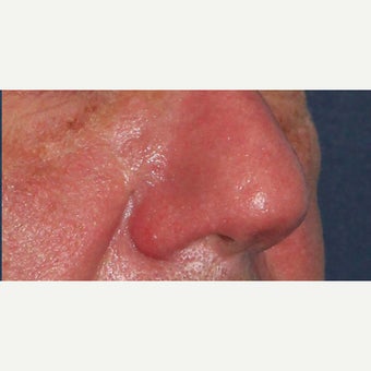 61 year old man treated with CO2 laser for rhinophyma (rosacea) of the nose 1783426