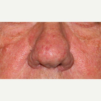 61 year old man treated with CO2 laser for rhinophyma (rosacea) of the nose before 1783426