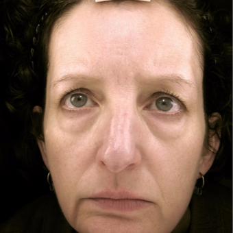 45-54 year old woman treated with Eyelid Surgery before 3489985