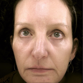 45-54 year old woman treated with Eyelid Surgery after 3489985