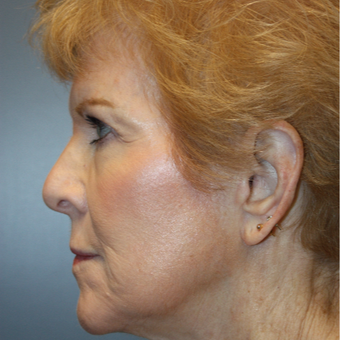 65-74 year old woman treated with Fraxel Laser after 3808364