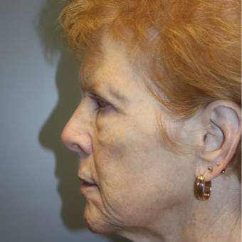 65-74 year old woman treated with Fraxel Laser before 3808364