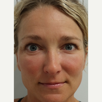 35-44 year old woman treated with Restylane after 3094240