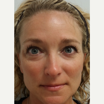 35-44 year old woman treated with Restylane before 3094240