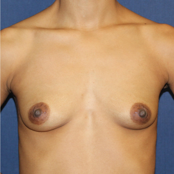 Breast Augmentation with Rapid Recovery before 3814397