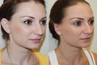 Otoplasty Surgery before 1075797