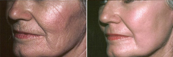 Chemical Peel before 1429286