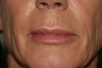 Lip Implant after 1116181