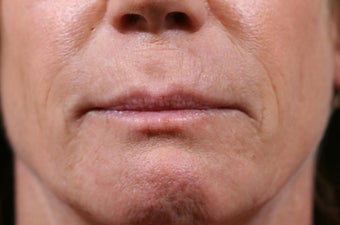 Lip Implant before 1116181