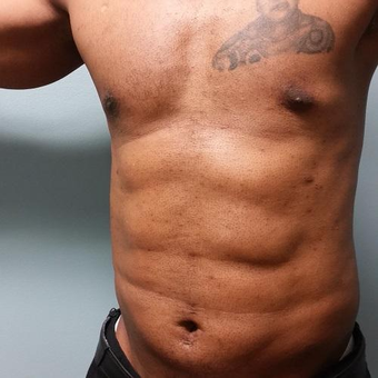 45-54 year old man treated with Laser Liposuction after 3763986