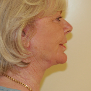 65-74 year old woman treated with Neck Lift after 3555290