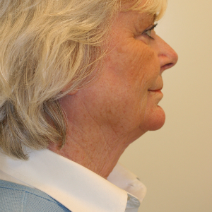 65-74 year old woman treated with Neck Lift before 3555290