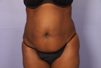 No Drain Tummy Tuck before 1195884