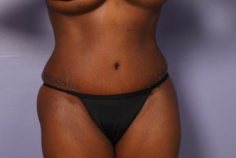 No Drain Tummy Tuck after 1195884