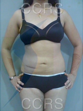 VASER Lipo - 25 yrs. old female (abdomen, back, flanks & thighs) after 636081