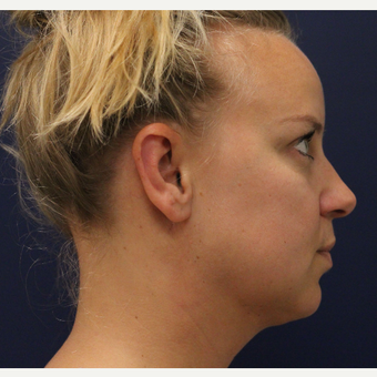 35-44 year old woman treated with Smart Lipo after 3143127