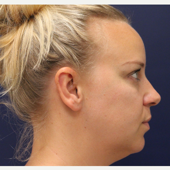 35-44 year old woman treated with Smart Lipo before 3143127