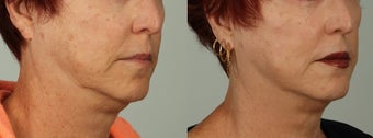66 year old woman treated with Infini RF before 3075107