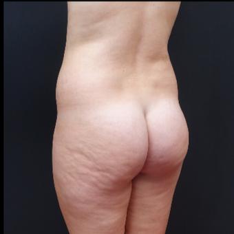 18-24 year old woman treated with Butt Lift before 3315510