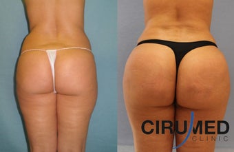 Brazilian butt lift surgery with Water-jetstream lipo before 1026624