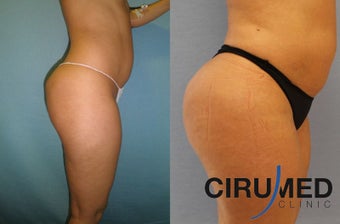 Brazilian butt lift surgery with Water-jetstream lipo 1026624