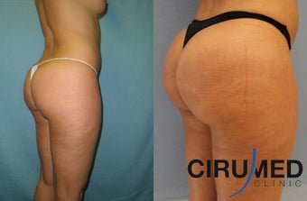Brazilian butt lift surgery with Water-jetstream lipo 1026624