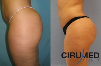 Brazilian butt lift surgery with Water-jetstream lipo after 1026624