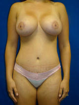 Limited (Benelli) Lift with Implants after 139101