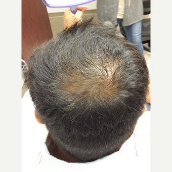 35-44 year old man treated with Propecia for Hair Loss after 3844921