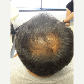 35-44 year old man treated with Propecia for Hair Loss before 3844921