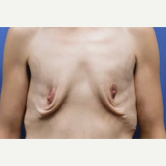 25-34 year old woman treated with Breast Lift before 3549189