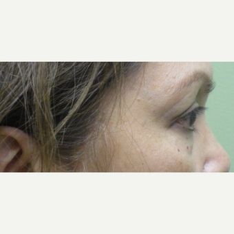 55-64 year old woman treated with Eye Bags Treatment before 3220080