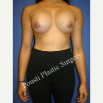 25-34 year old woman treated with Breast Implants after 3651220
