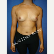 25-34 year old woman treated with Breast Implants before 3651220