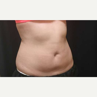 18-24 year old woman treated with CoolSculpting after 3747879