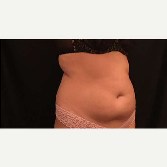 18-24 year old woman treated with CoolSculpting before 3747879