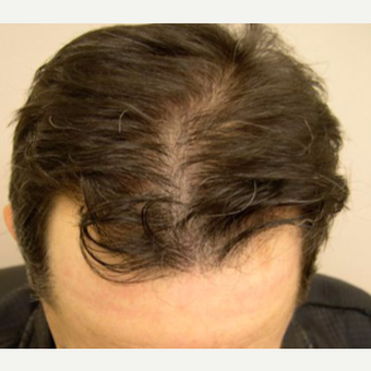 Hair Transplant after 3529299