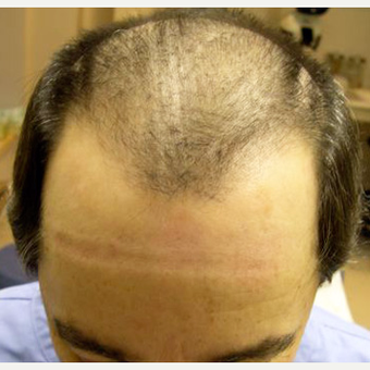Hair Transplant before 3529299